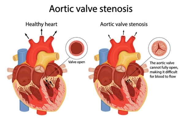 A diagram shows a healthy heart beside a heart with aortic stenosis.