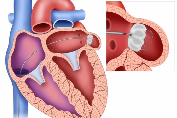 A diagram of the human heart shows a WATCHMAN implant being placed using a catheter.