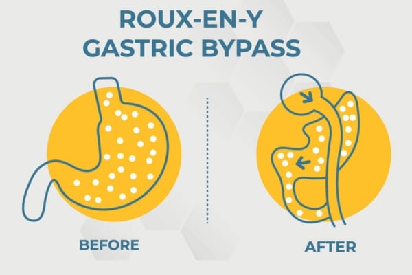 A diagram shows how a Roux-en-Y gastric bypass reconfigures the digestive tract.