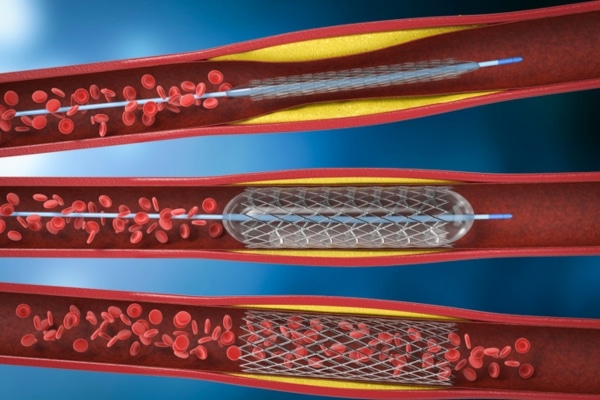 Three images show how balloon angioplasty opens a blocked artery and places a stent.