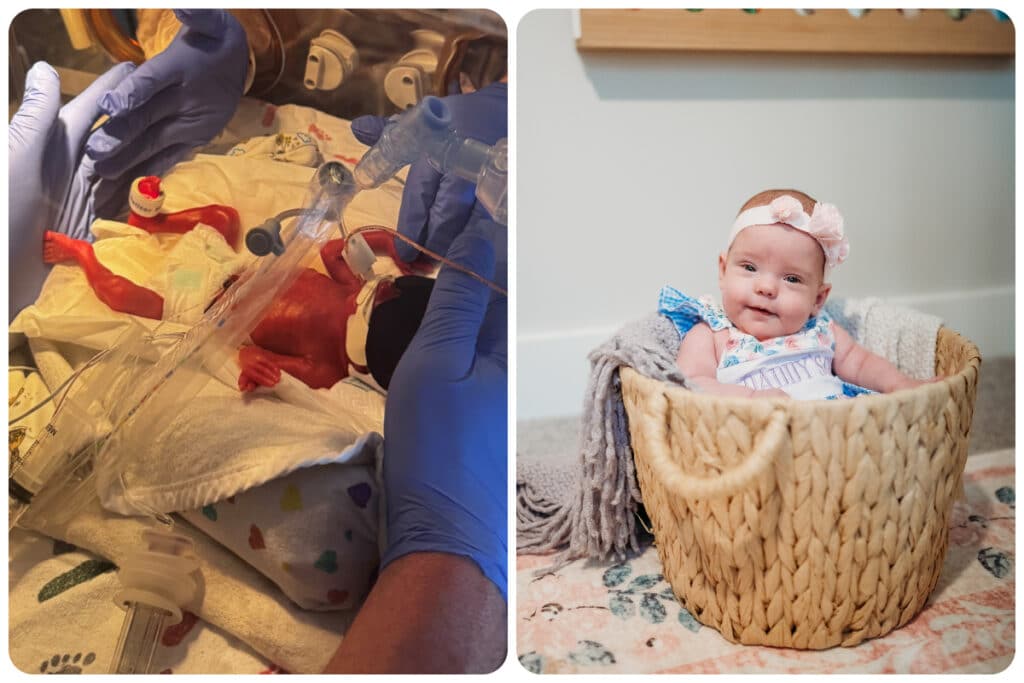 A collage shows preemie Poppy DeWald in the NICU and at home after her release.