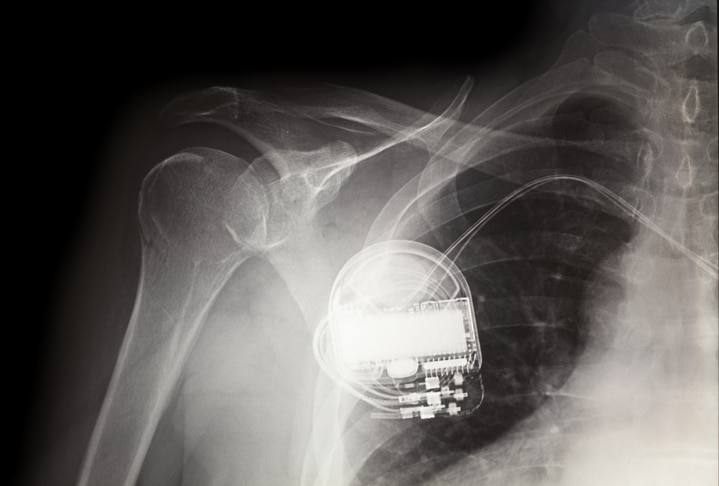An X-ray shows a pacemaker implanted under a patient's skin.