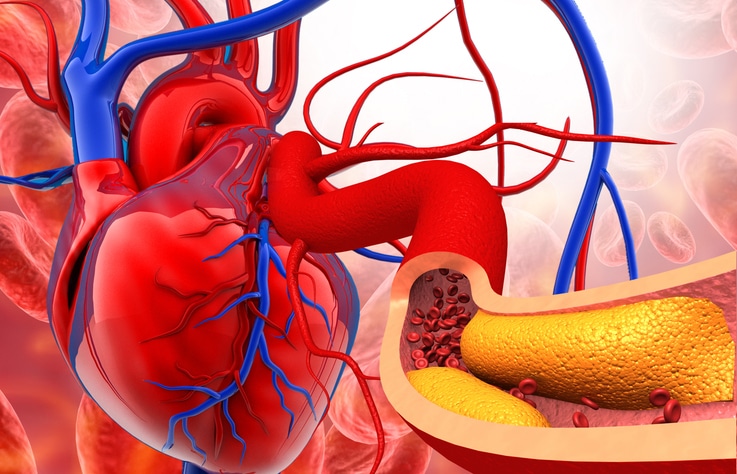 Cholesterol plaque in artery with human heart anatomy. 3d illustration