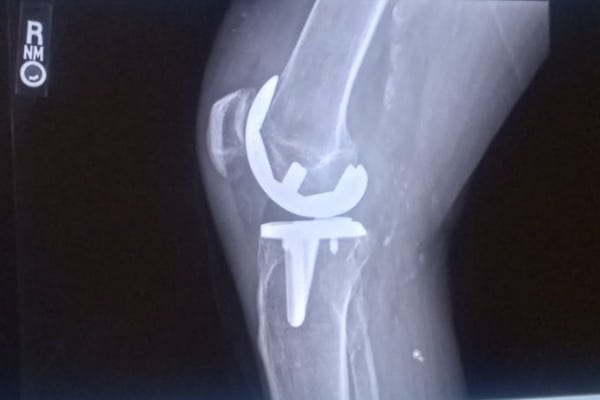 An X-ray shows Larry Revels artificial knee.