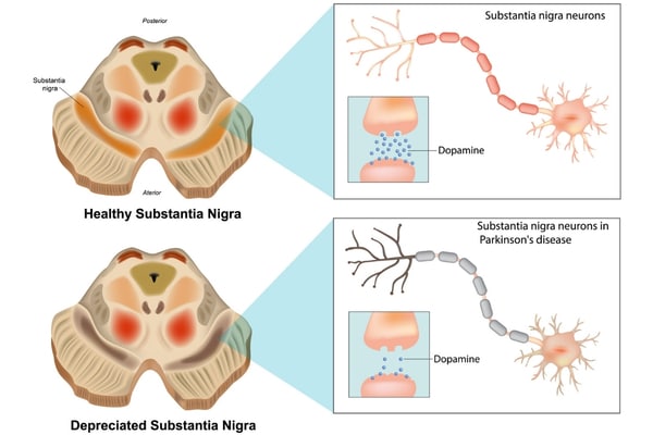 An illustration the difference between a health brain and a brain of someone with Parkinson's disease.