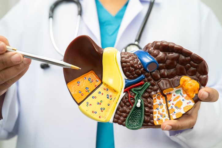 Cirrhosis, Liver cancer, fatty liver, Asian doctor with liver human model