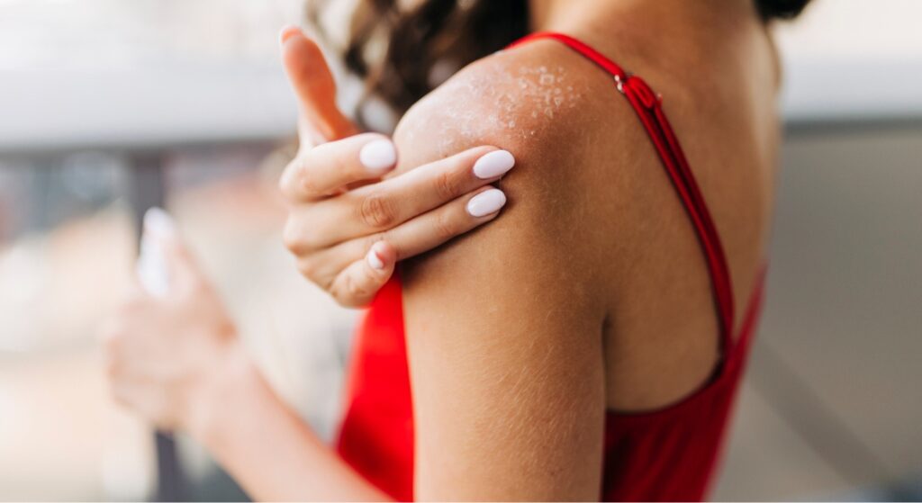Close up of woman applying moisturizer on sunburned skin