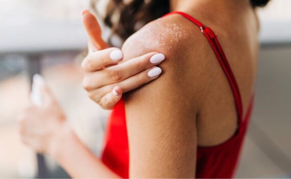 Close up of woman applying moisturizer on sunburned skin