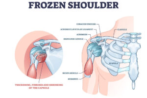 Diagram shows the anatomy of frozen shoulder.