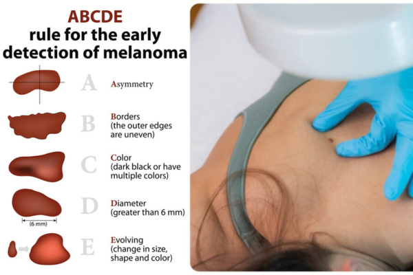 A graphic shows the ABCDEs of melanoma